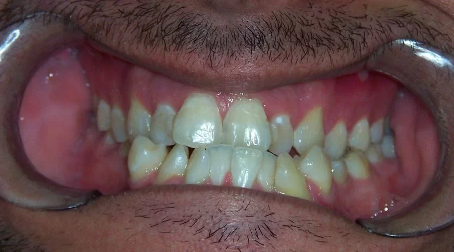 What is the Main Cause of Crooked Teeth?