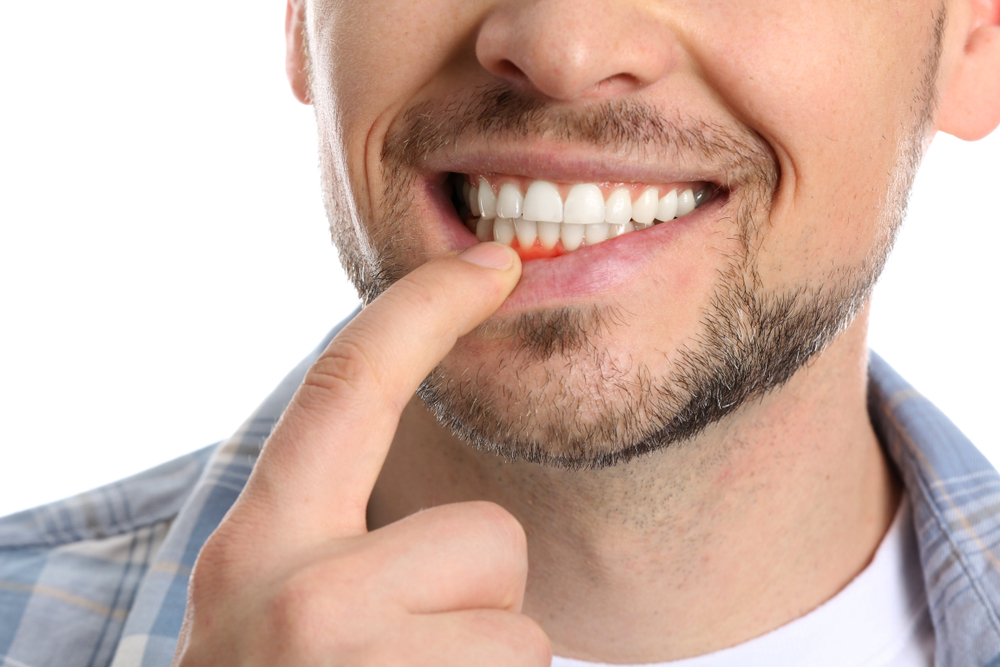 Close up of a man's smile showing a chipped tooth in the Hampton community 
