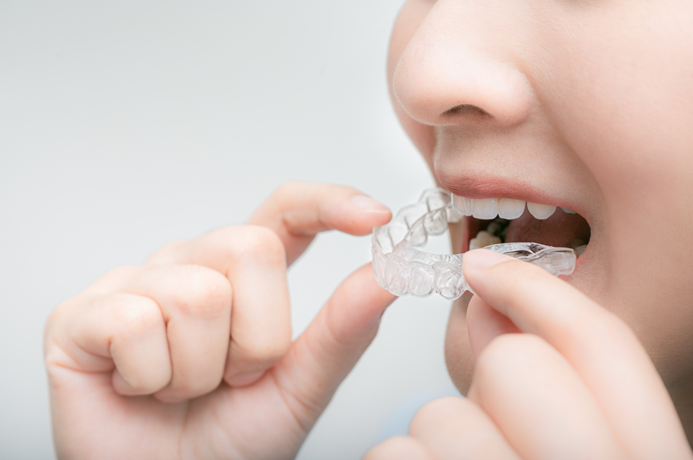 Woman wearing orthodontic silicone trainer. Mobile orthodontic appliance for dental correction. tooth whitening systems.