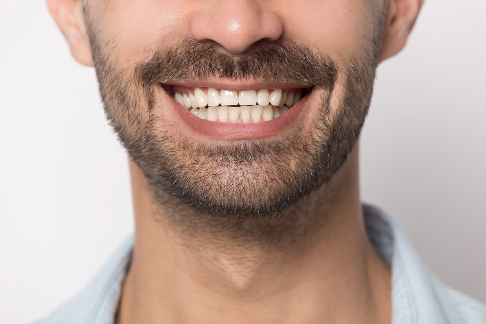 Dental implant smile results in Norfolk, VA, The Foleck Center Close-up of a man's bright, straight smile, reflecting dental implant results at The Foleck Center, Norfolk, VA